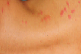 bedbugs